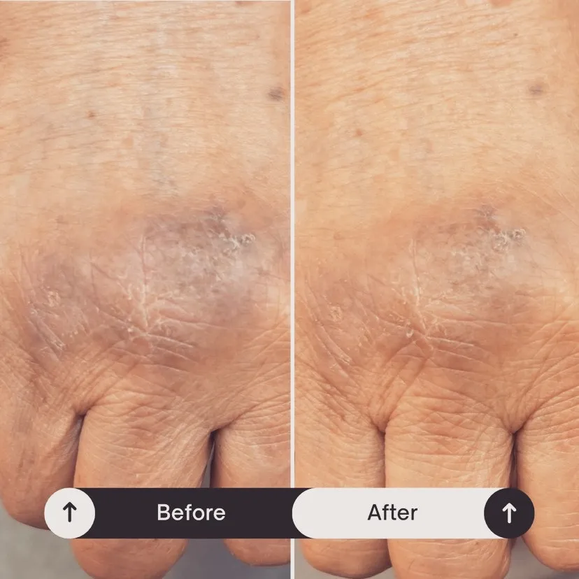 手の甲のかゆみ